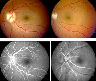 esclerosis multiple